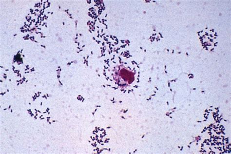 Streptococcus pneumoniae gram stain of sputum as shown above picture. Case 100