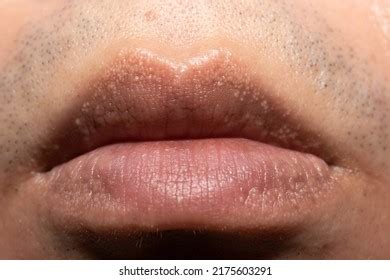 Close Fordyce Spots On Lips Stock Photo Shutterstock