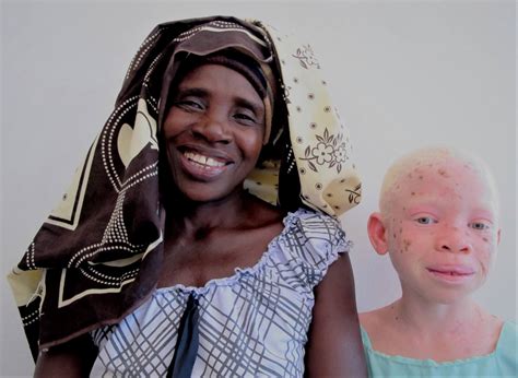 Why Are There More People With Albinism In Africa Than In Europe