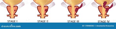 Stages Of Prostate Cancer From I To Iv The Tumor Grows And Penetrates