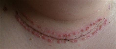Pictures Of My Scar They Are Quite Big Sorry Thyroid Cancer Group