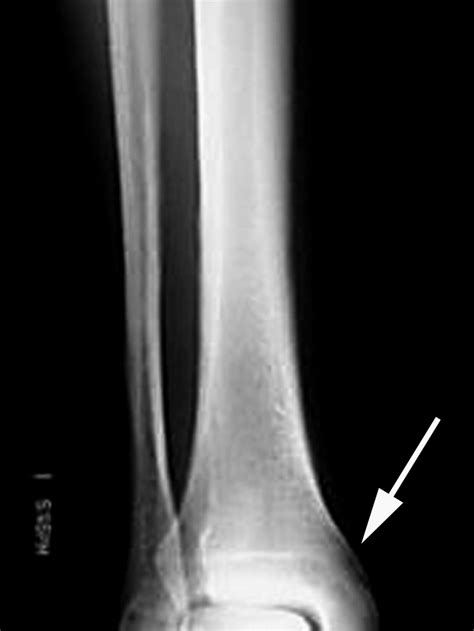 Plain X Ray Of Tibia And Fibula Showing Cortical Elevation Typical Of