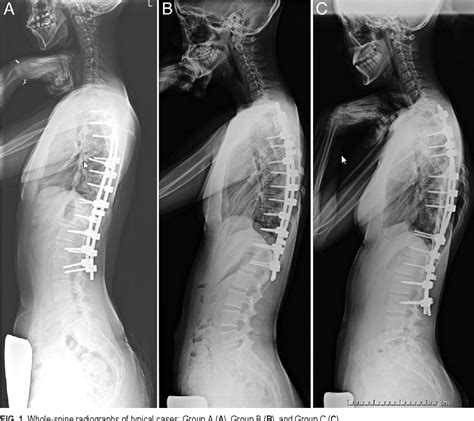 Figure 1 From Cervical Lordotic Alignment Following Posterior Spinal