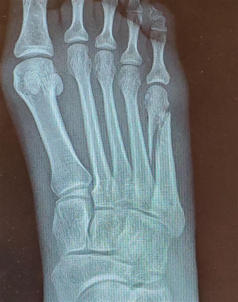 My 5th Metatarsal Fracture Ouch Rmedizzy