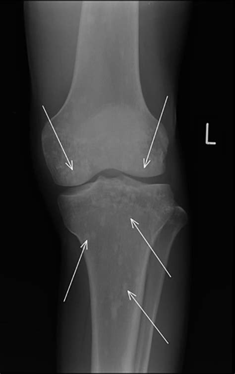An Incidental Finding On A Knee Radiograph The Bmj