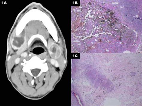 Bilateral Cervical Nodal Metastasis From Unknown Primary Melanoma A