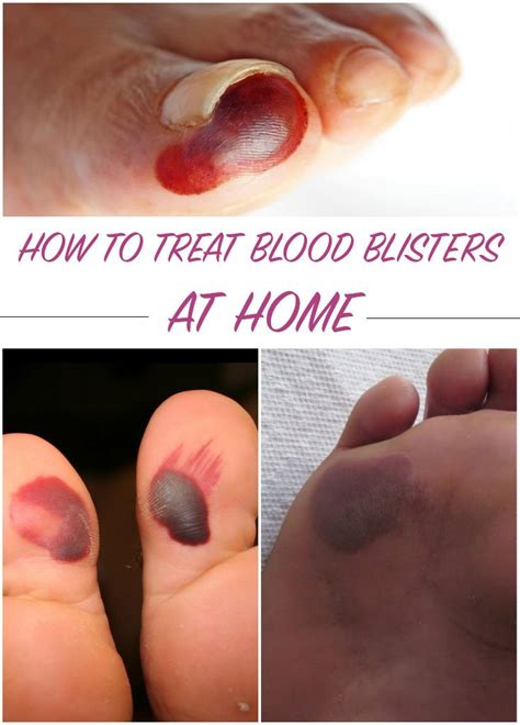 How To Treat Blood Blisters At Home Everything In One Place