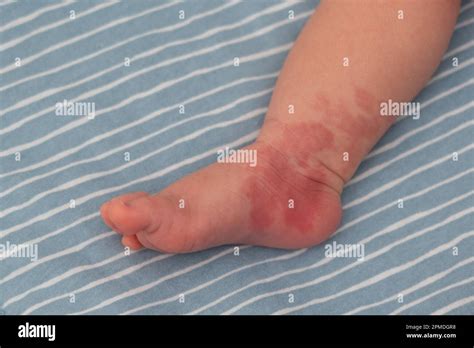 Hemangioma Red Birthmark On Leg Of Newborn Baby Stock Photo Alamy