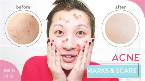 How To Treat Acne Scars From The Inside Out Best For Her