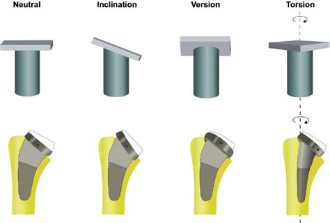 This Illustration Shows The Different Changes In Humeral Component