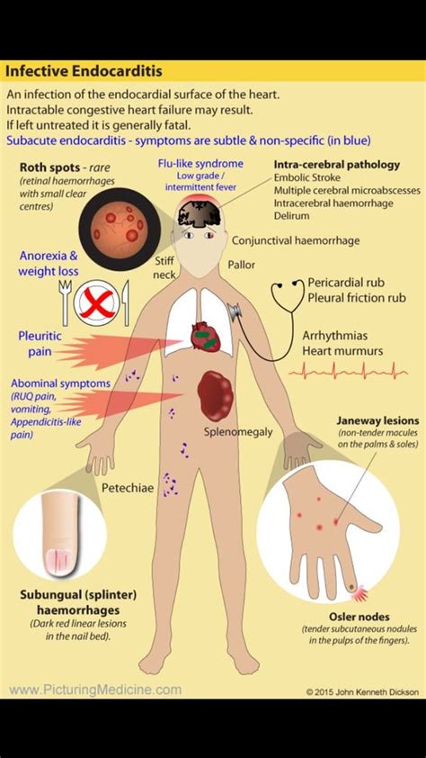 Clinical Manifestations Of Infective Endocarditis Diagnosis Grepmed