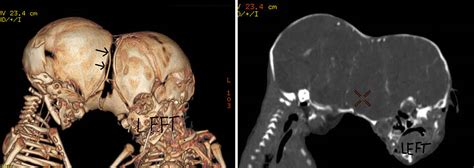 Emergency Separation Of Craniopagus Twins Case Report In Journal Of