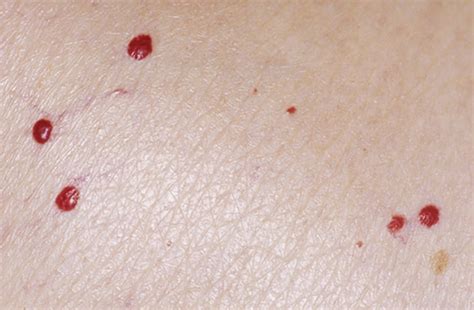 I have several on my. Cherry Angiomas - Finesse Skin Clinic