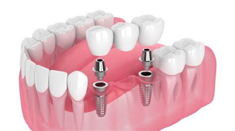 Ponte Fixa 4 Elementos