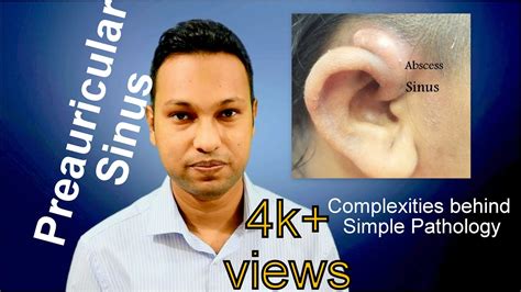 Preauricular Sinus Complexities Behind Simple Pathology Youtube