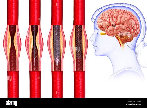 Illustration Of Brain Stent Angioplasty To Treat And Prevent A Stroke