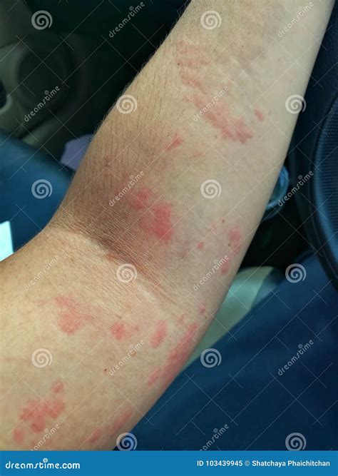 Allergic Dermatitis On The Skin Of A Woman`s Back Skin Disease