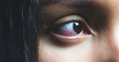 Watery Eyes Causes When To See A Doctor And Treatment