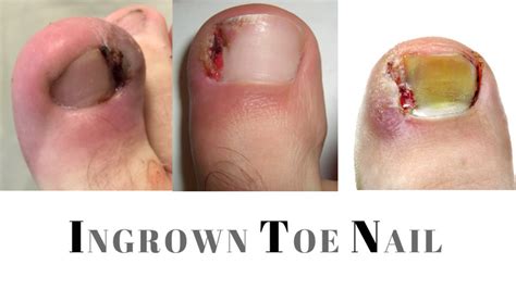 Read about an ingrown toenail, which develops when the sides of the toenail grow into the surrounding skin. Ingrown Toenail Treatment Singapore | Causes and Prevention