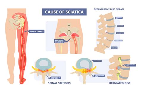 Piriformis Sciatic Nerve Block Herniated Disc And Sciatica Pain My XXX Hot Girl
