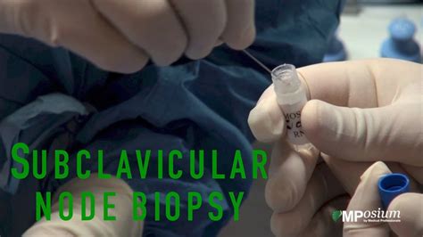 Subclavicular Node Biopsy Youtube