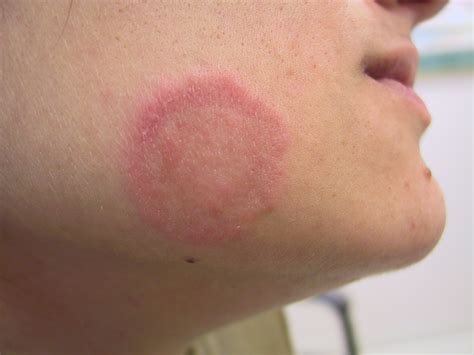 Pic Of Ringworm Pictures Photos