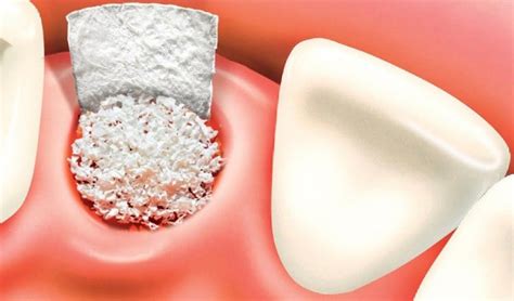 Bone Graft Vancouver Bone Graft Options For Dental Implants