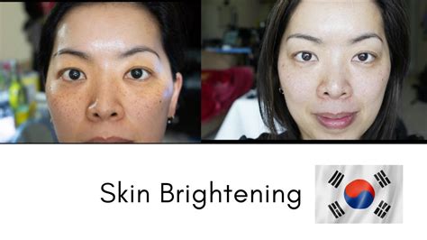 Skin Whitening In Korea Seoul Guide Medical Youtube