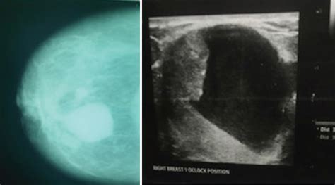 Breast Cysts With Masses Versus Breast Masses With Cysts Sonographic