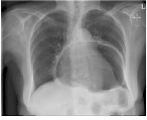 Diaphragmatic Hernia Chest X Ray