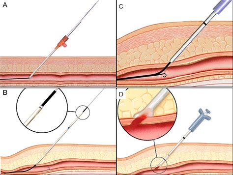 Access Site Management With Vascular Closure Devices For Percutaneous