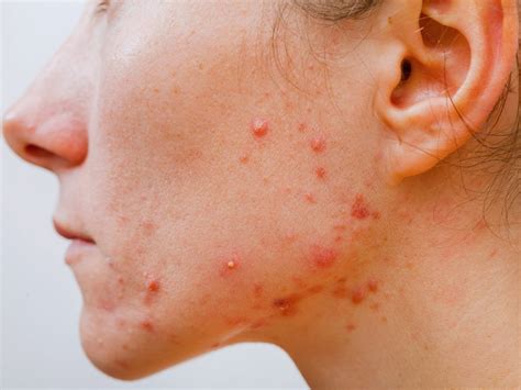 Having Acne In Your Teens Makes You A Successful Adult According To A