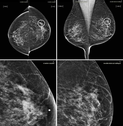 Ai Tool Improves Breast Cancer Detection On M Eurekalert