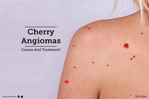 Cherry Angiomas Causes And Treatment By Sakhiya Skin Clinic Private Limited Lybrate