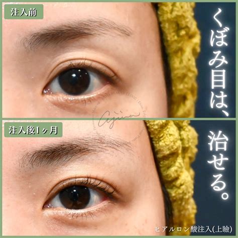 くぼみ目を治して、明るく若々しい印象に。 美容外科医・dr安嶋 あじ先生 のブログ『あじブロ』