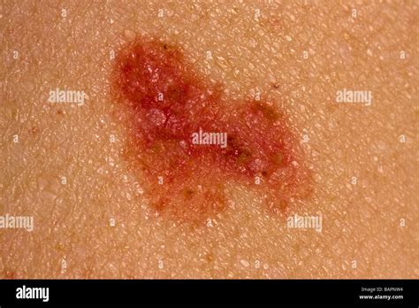 Rodent Ulcer Hi Res Stock Photography And Images Alamy