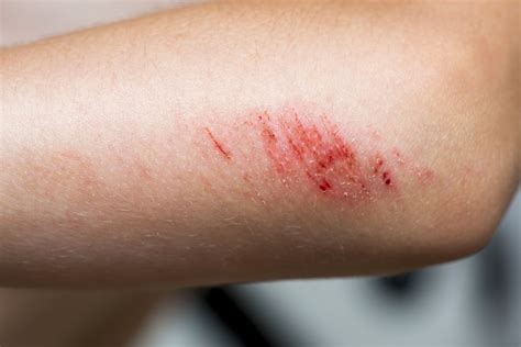 Treating Abrasions Physicians Immediate Care