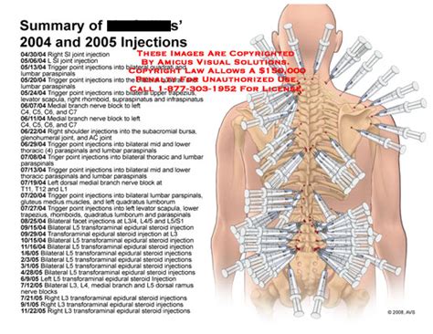 A trigger point injection (tpi) involves the injection of medication such as steroids and/or anesthetic directly into the trigger point to alleviate pain. Medical Exhibits, Demonstrative Aids, Illustrations and Models