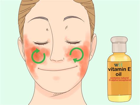Is Vitamin E Good For Eczema Vitaminwalls