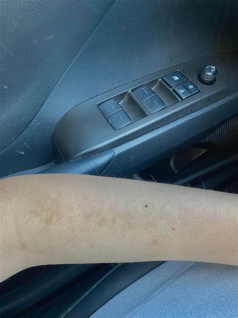 I Have These Dark Patches On Both Of My Arms My Other Arm Has It Too