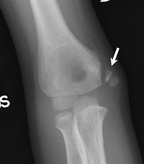 Elbow Grease Lateral And Medial Condyle Fractures Of The Humerus