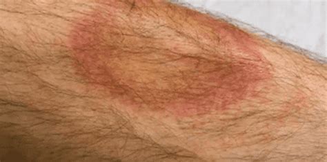 Tick Bite Pictures Symptoms Causes Treatment Youmemindbody