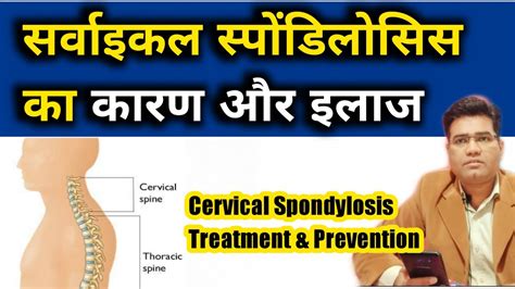 What Are Cervical Spondylosis Neck Pain Cause Symptoms And Treatment