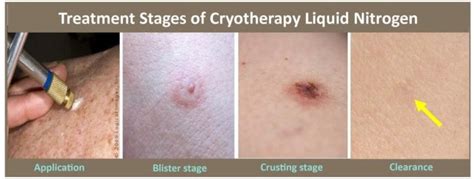 Treatment Stages Of Cryotherapy Liquid Nitrogen Cosmetic Skin Care