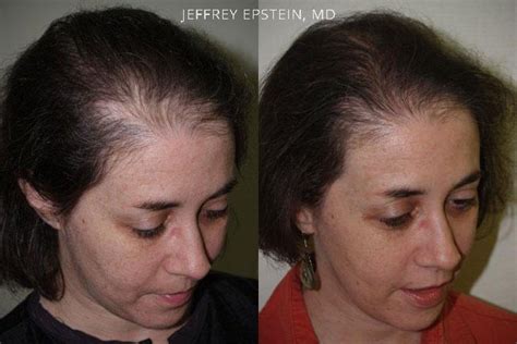 Hair Transplants For Women Photos Miami Fl Patient41789