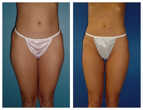 The outer thigh incisions are made near the hip bones as well as on the sides of the thighs. Female Inner & Outer Thighs Liposuction by Dr. William ...