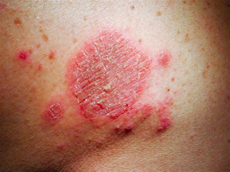 Nahaufnahme Allergischer Hautausschlag Dermatitis Ekzem Auf Der Haut