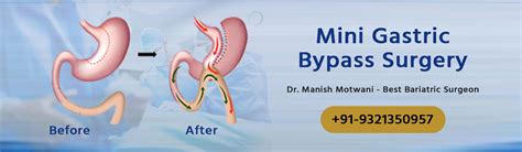 Mini Gastric Bypass Weight Loss Treatments Cost And Procedures
