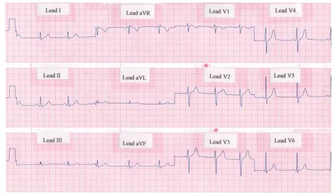 Electrocardiogram ECG EKG Definition Readings Procedure