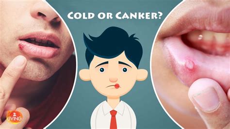 Is It A Cold Sore Or A Canker Sore How To Tell The Difference Canker